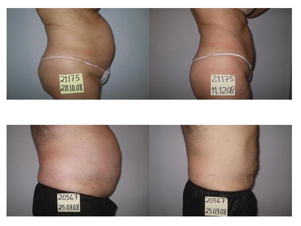 Cómo perder grasa abdominal  CLÍNICA DO TEMPO – Dr. Humberto
