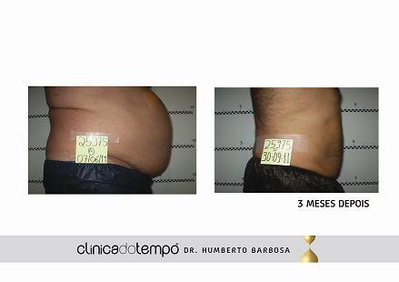 Cómo perder grasa abdominal, CLÍNICA DO TEMPO – Dr. Humberto Barbosa