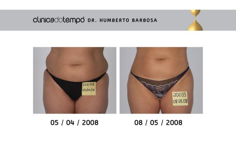 Com o Liposhaper é possível perder até 10 centímetros num mês