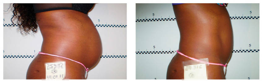 foto-antes-depois-11