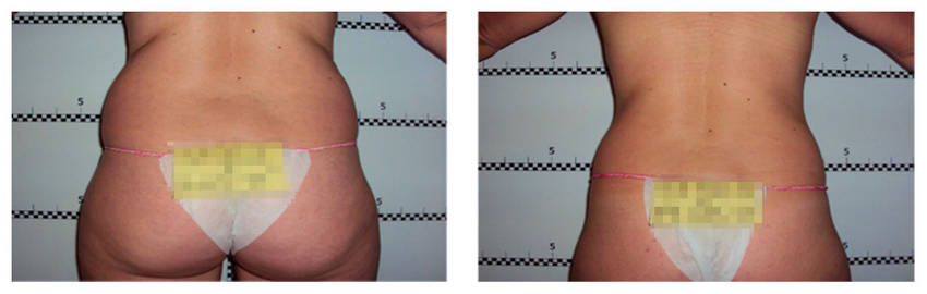 foto-antes-depois-14