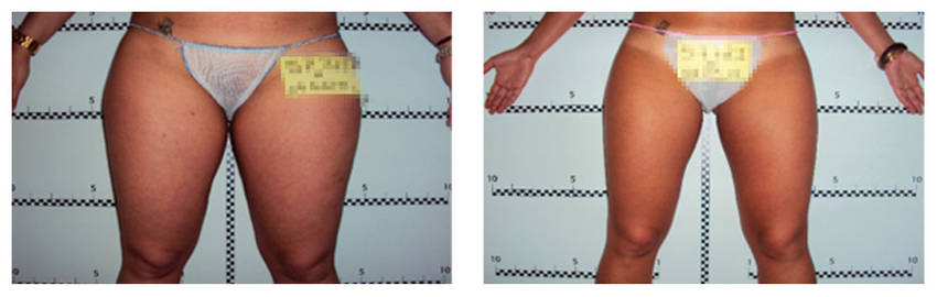 foto-antes-depois-23