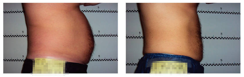 foto-antes-depois-32