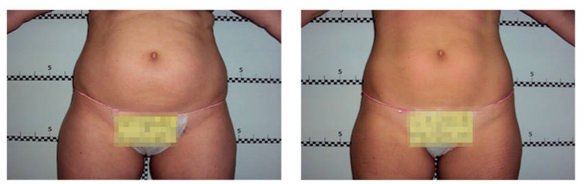 foto-antes-depois-33