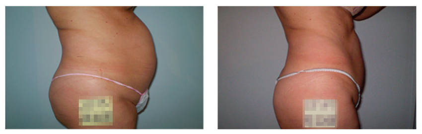 foto-antes-depois-35