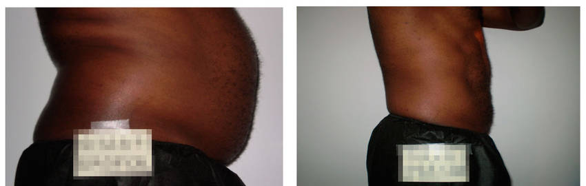 foto-antes-depois-36